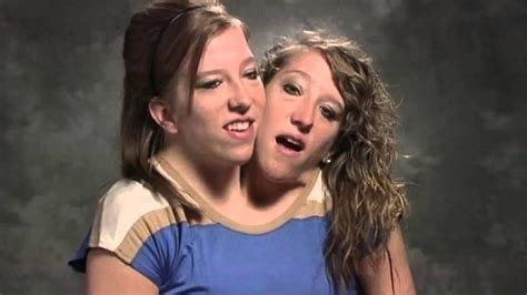 conjoined twins porn|conjoined twins Search